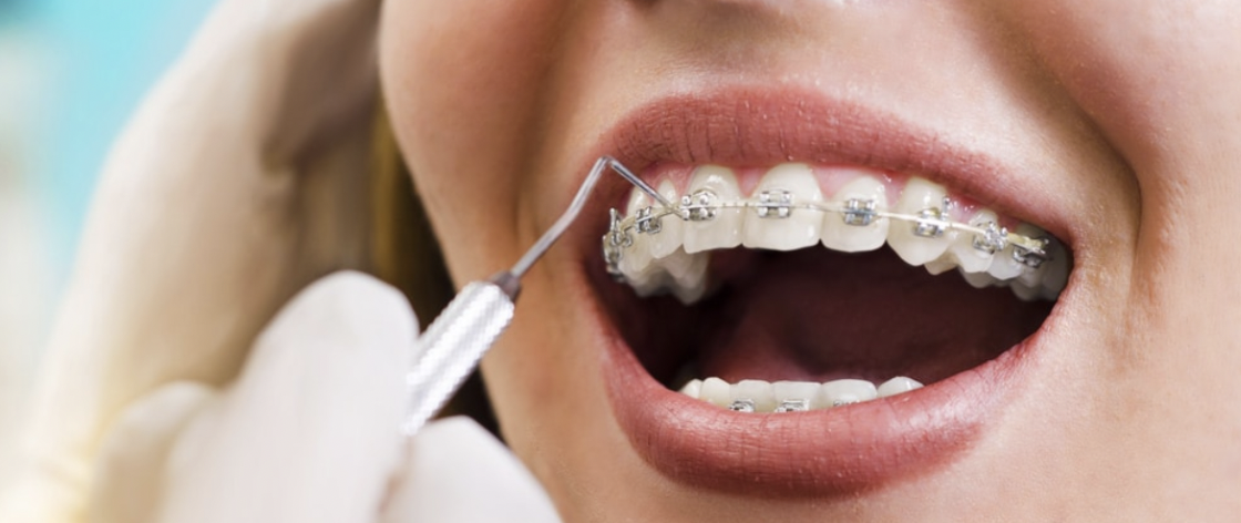 Orthodontic Truth Guide Breaking False Beliefs About Modern Teeth Alignment